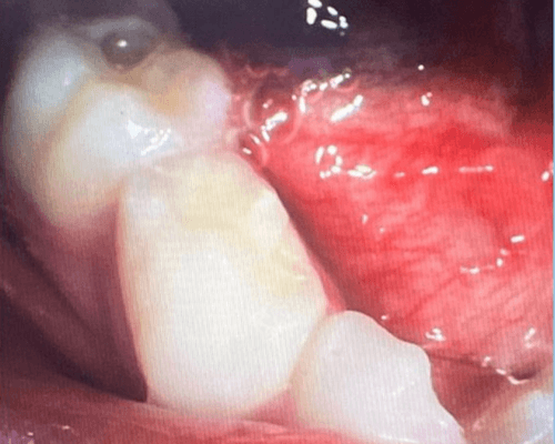 Tambal Gigi Anak after treatment