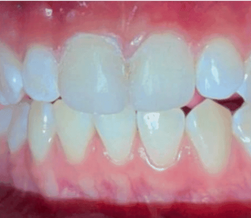 Tambal Gigi Anak after treatment