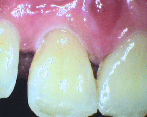 Scaling + Pembersihan Stain after treatment