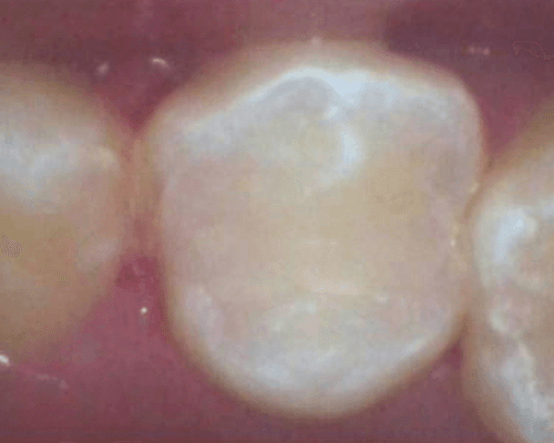 Tambal Gigi after treatment