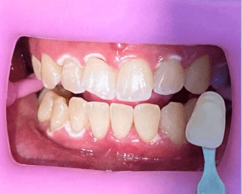 Bleaching (Pemutihan Gigi) after treatment