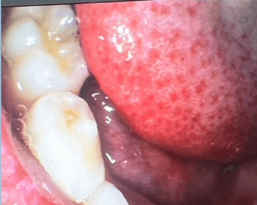 Tambal Gigi Anak before treatment